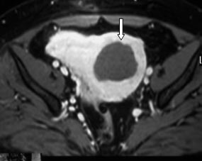 After performing ultrasonic ablation (own observation), the ablation amount is 89% (arrow).