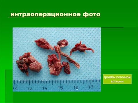 интраоперационное фото: тромбы легочной артерии