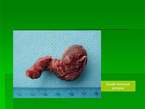 интраоперационное фото: тромб легочной артерии