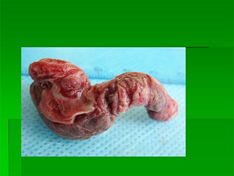 интраоперационное фото: тромб легочной артерии