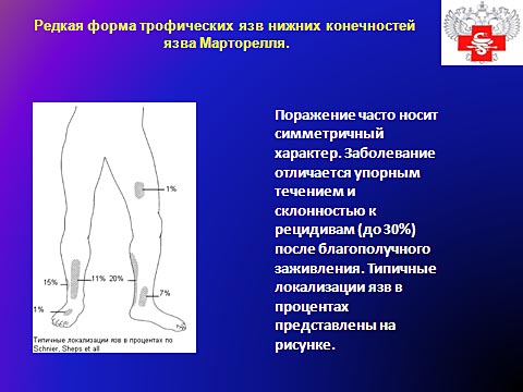 Редкая форма трофических язв нижних конечностей, язва Марторелля