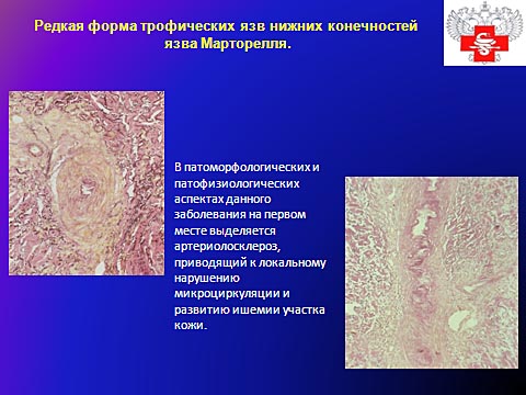 Редкая форма трофических язв нижних конечностей, язва Марторелля