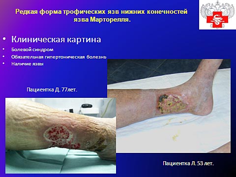 Редкая форма трофических язв нижних конечностей, язва Марторелля