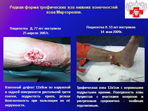 Редкая форма трофических язв нижних конечностей, язва Марторелля