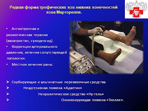 Редкая форма трофических язв нижних конечностей, язва Марторелля
