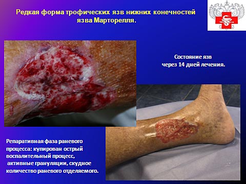 Редкая форма трофических язв нижних конечностей, язва Марторелля
