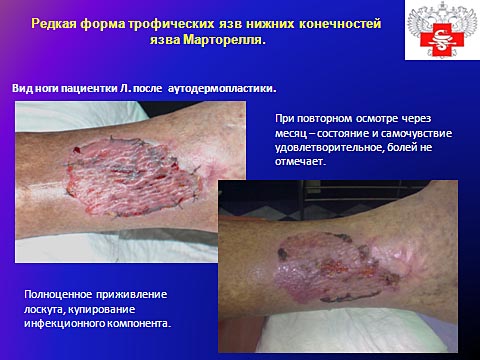 Редкая форма трофических язв нижних конечностей, язва Марторелля