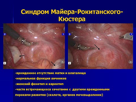 Синдром Майера-Рокитанского-Кюстера