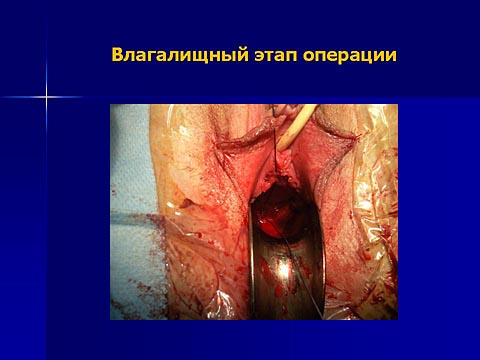 Влагалищный этап операции
