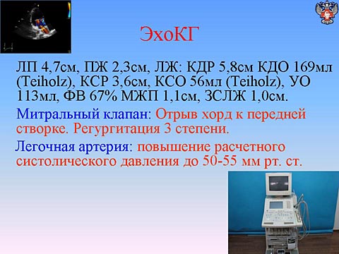 ЭхоКГ