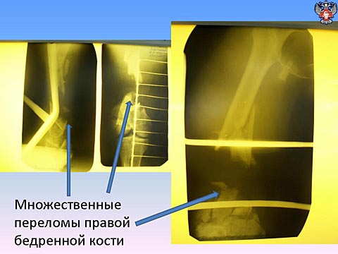Множественные переломы правой бедренной кости
