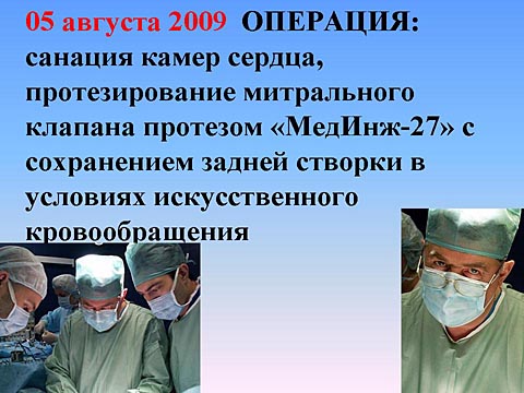 Операция: протезирование митрального клапана