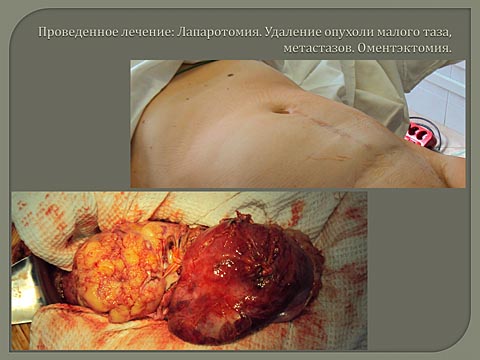 Лечебная тактика при нерезектабельной саркоме тела матки