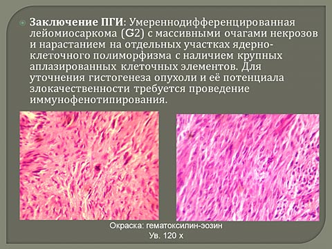 Лечебная тактика при нерезектабельной саркоме тела матки