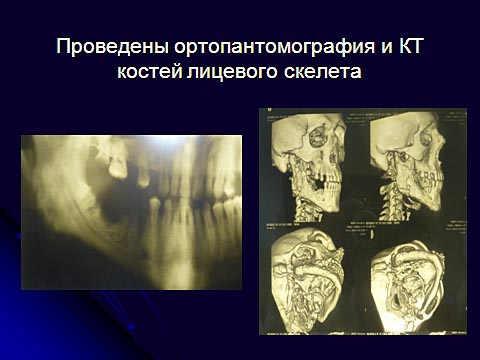 Хронический токсический остеомиелит челюстей на фоне приема кустарно изготовленного наркотического препарата дезоморфина