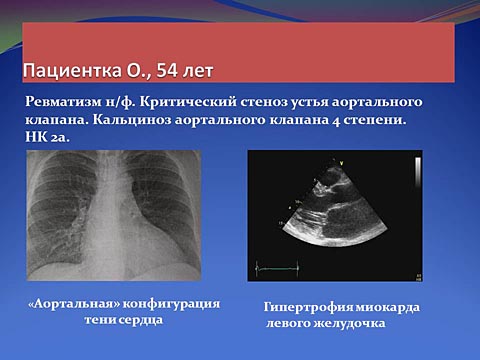 Критический стеноз устья аортального клапана