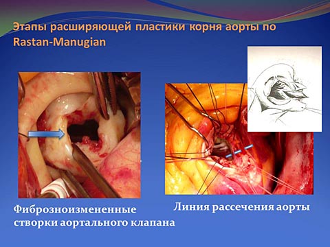 Этапы расширяющей пластики корня аорты по Rastan-Manugian