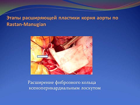 Этапы расширяющей пластики корня аорты по Rastan-Manugian
