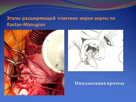 Этапы расширяющей пластики корня аорты по Rastan-Manugian
