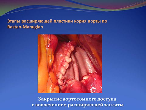 Этапы расширяющей пластики корня аорты по Rastan-Manugian