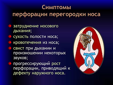 Носовая перегородка код по мкб 10. Перфорация перегородки носа симптомы. Перфорация носовой перегородки презентация. Перфорация носовой перегородки мкб. Перфорация носовой перегородки мкб 10.