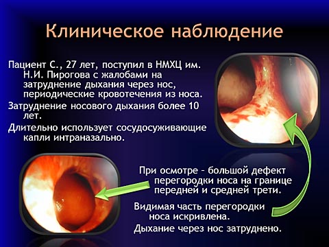 Клиническое наблюдение - большой дефект перегородки носа