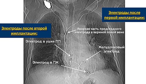 Рентгенограмма