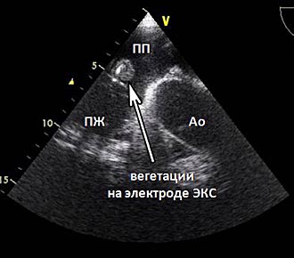 Вегетации на клапанах. Инфекционный эндокардит ЭХОКГ. Вегетации при эхокардиографии. ЭХОКГ при инфекционном эндокардите.