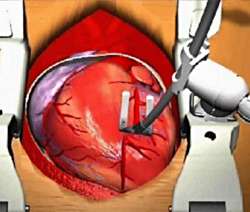 Использование механического стабилизатора стенки для выполнения аортокоронарного шунтирования на работающем сeрдце