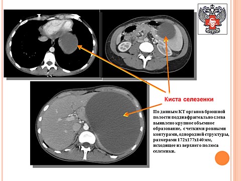 Лечение кисты селезенки
